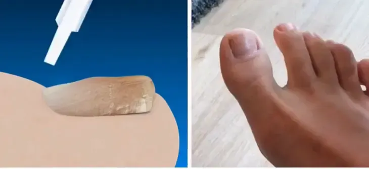 Nahaufnahme des blauen Behandlungsstifts in seiner sauberen Verpackung.